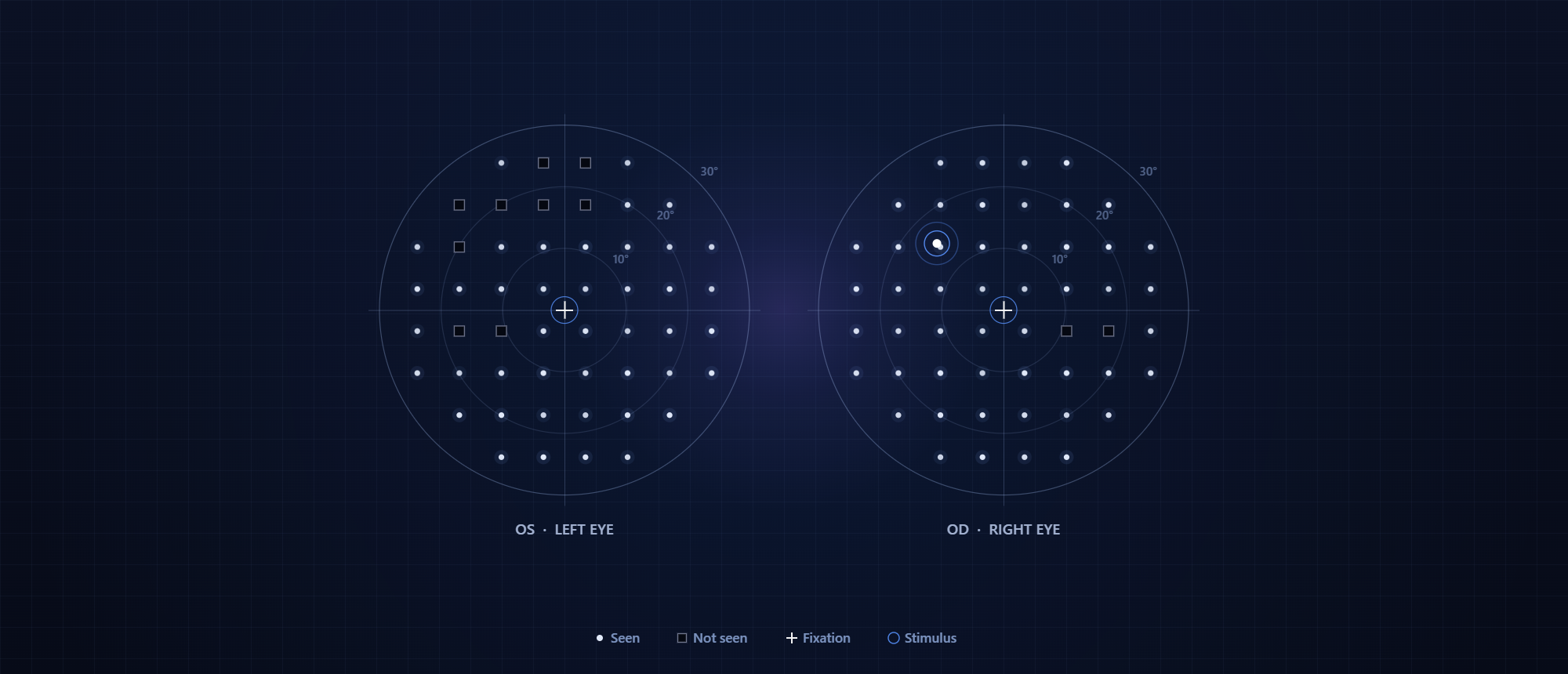 Visual field test results for both eyes, showing seen and missed test points around the fixation target